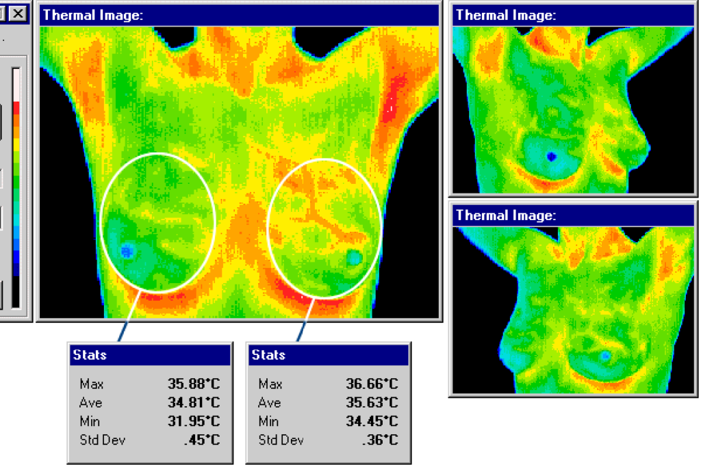 thermography