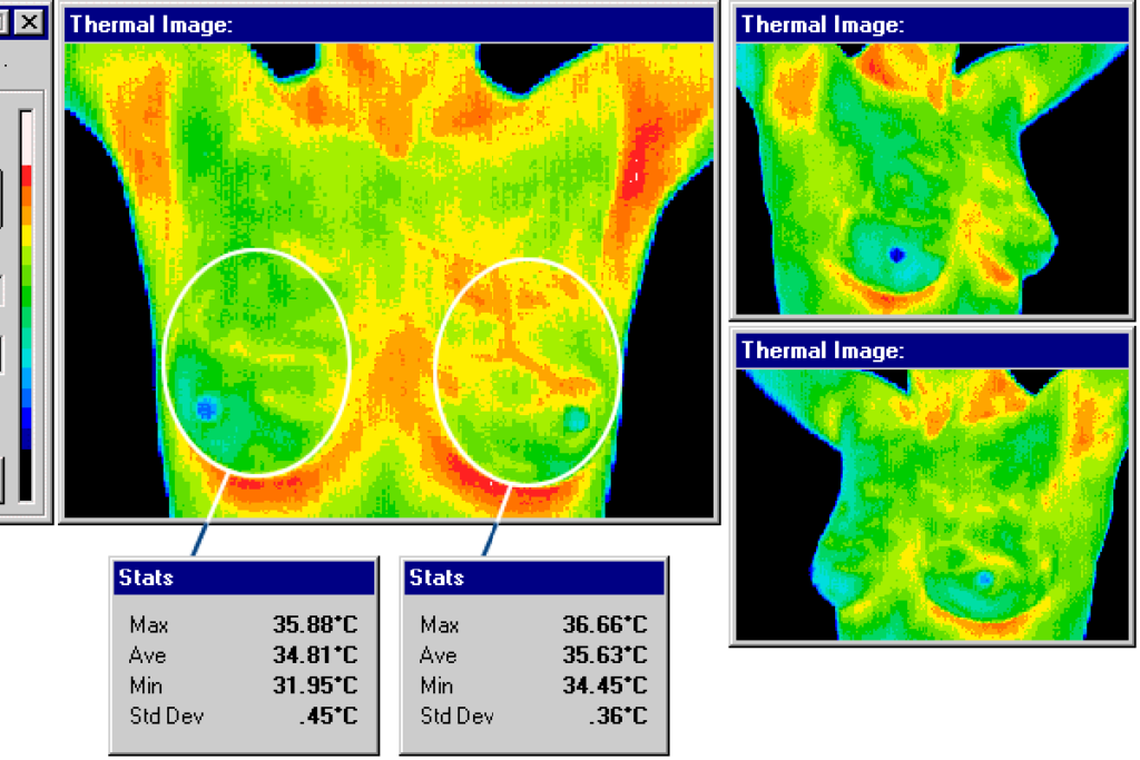 breast thermography